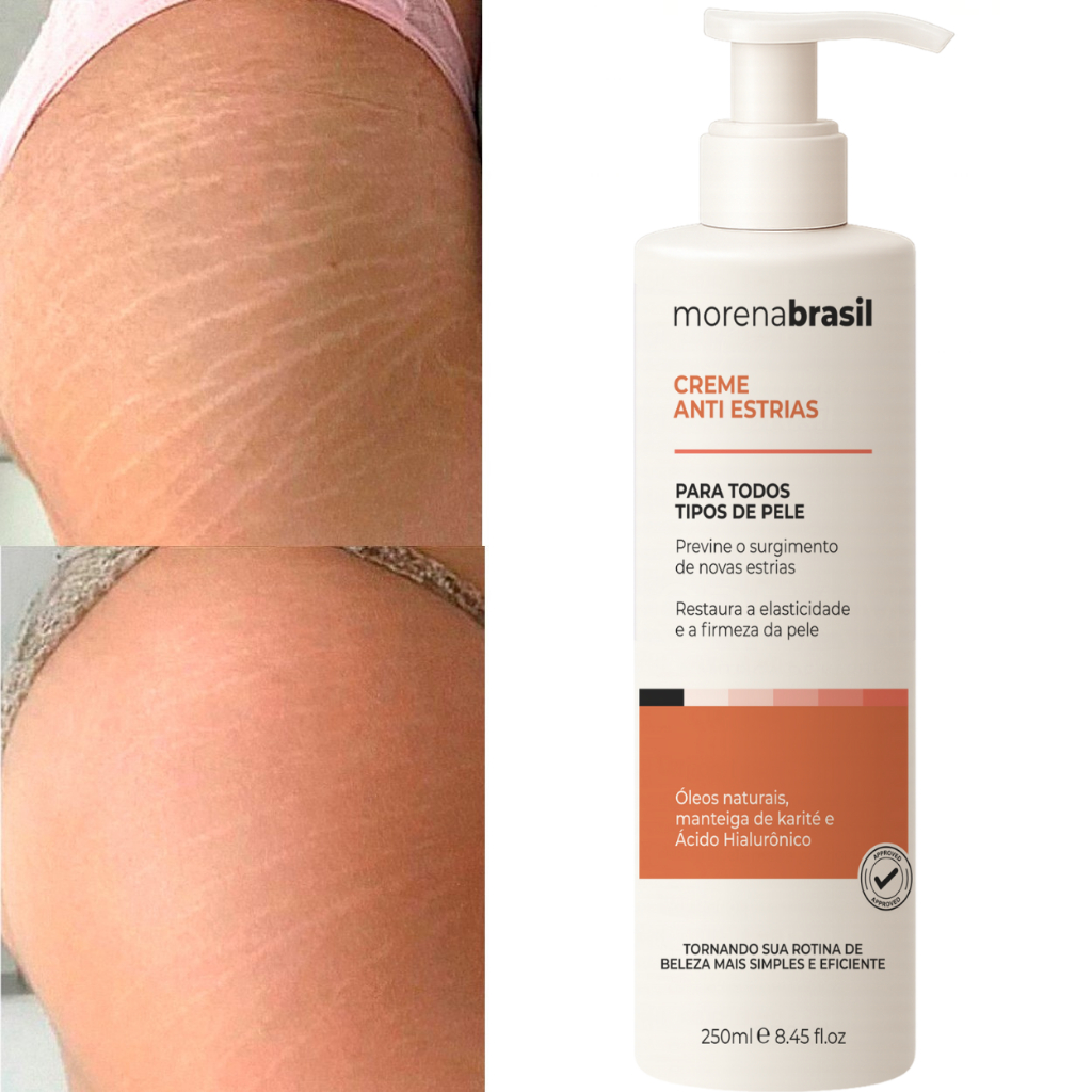 Creme Anti-Estrias Morena Brasil - Previne novas estrias | Reforça a elasticidade da pele